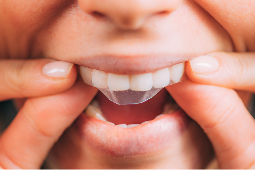 Hydrogen Peroxide vs. PAP: A Comparison of Teeth Whitening Agents